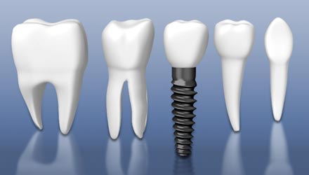 Implantologie – Implantate als künstliche Zahn­wurzeln bieten durch medi­zi­ni­sche, funktio­nelle und ästhe­tische Aspekte einen Gewinn an Kau­komfort und Lebens­qualität.
